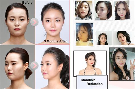 roi plastic surgery korea.